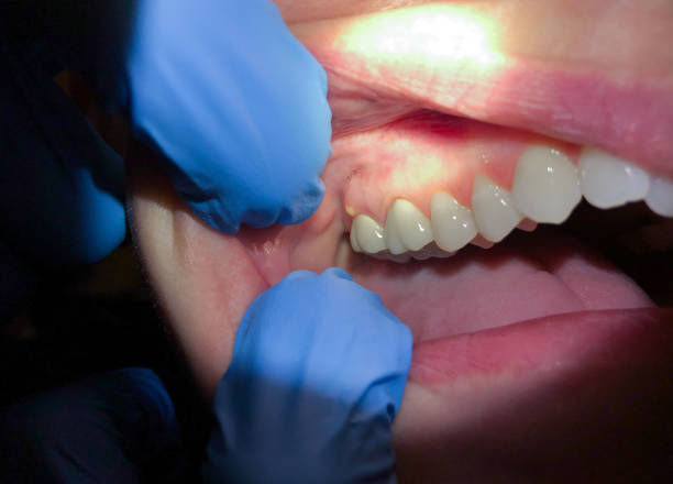 Best Emergency Treatment for Dental Infections or Abscesses in Okeechobee, FL